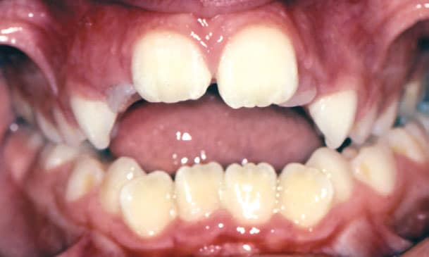 Open bite Reznik Orthodontics in Odessa and Midland, TX